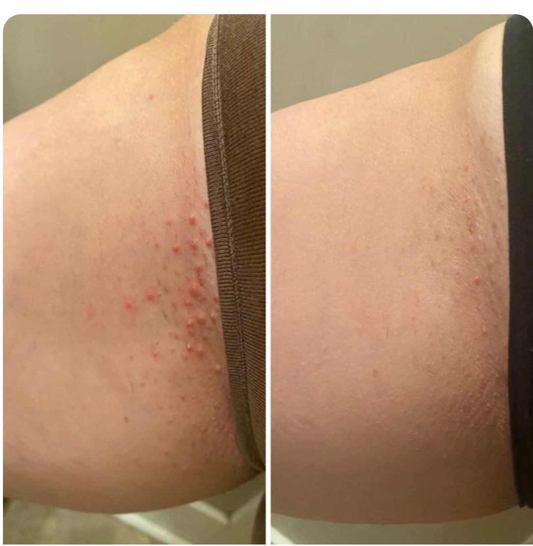 Unique Ingrown hair oil
